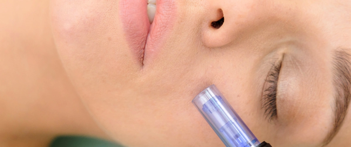 Microneedling Results