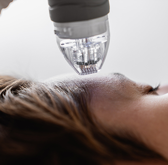 Microneedling Stamp RF