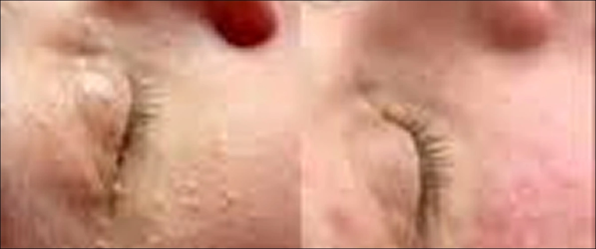 Milia Removal