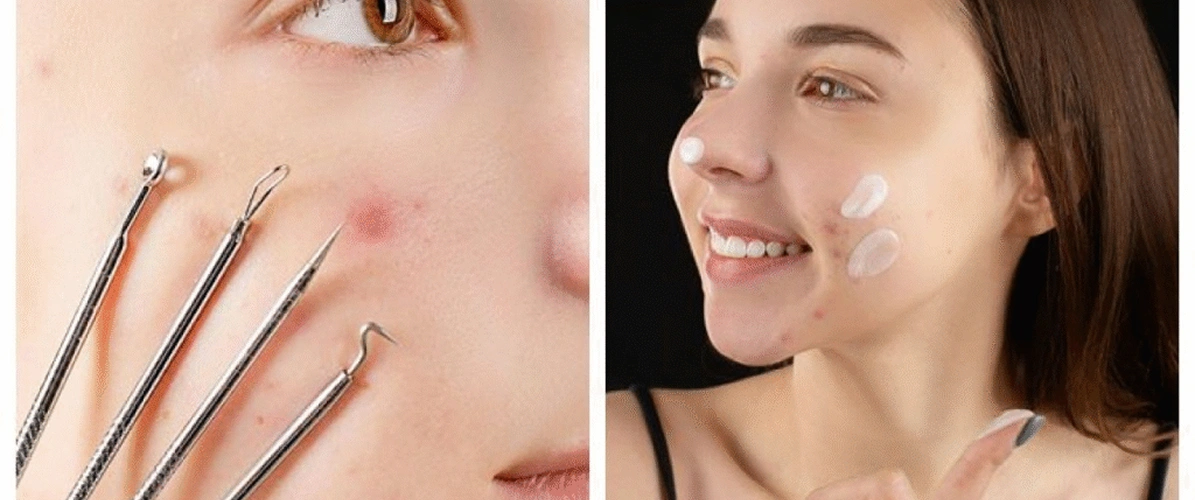 Milia Removal