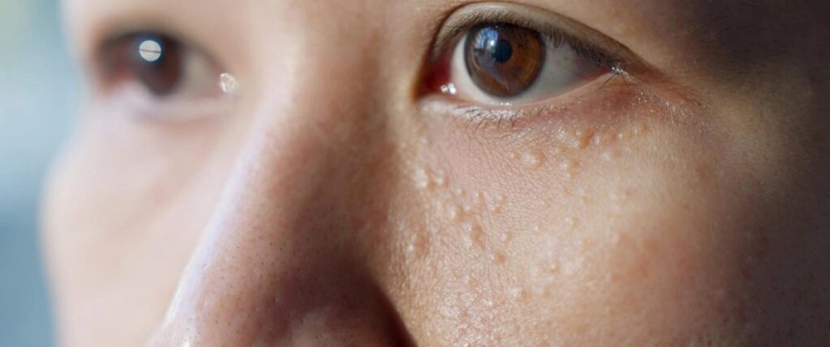 Milia on Eyelid