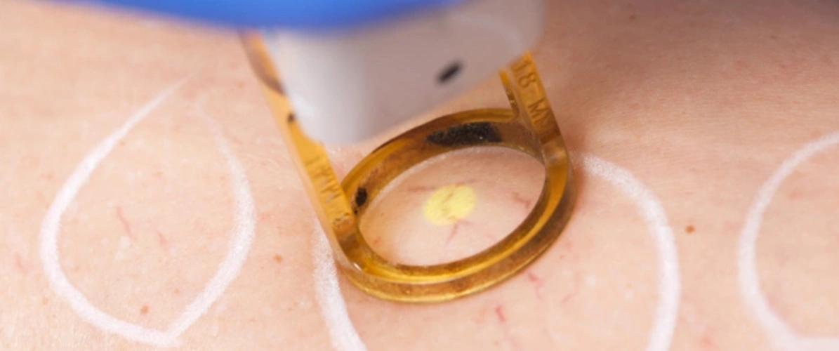 NDYAG Laser