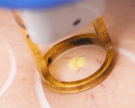 NDYAG Laser