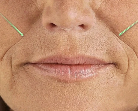Nose to Mouth Lines Nasolabials