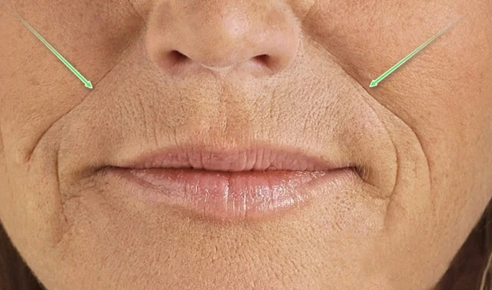 Nose to Mouth Lines Nasolabials