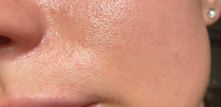 Oily Skin Enlarged Pores