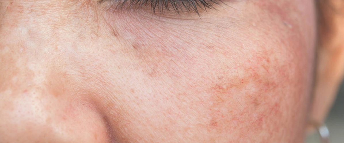 Photofabulous Treatment
