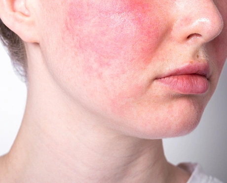 Redness Rosacea