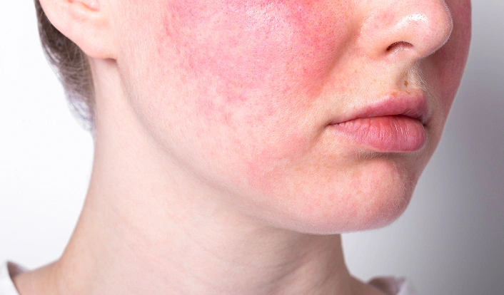 Redness Rosacea