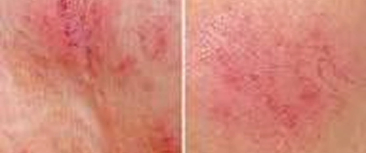Redness Rosacea