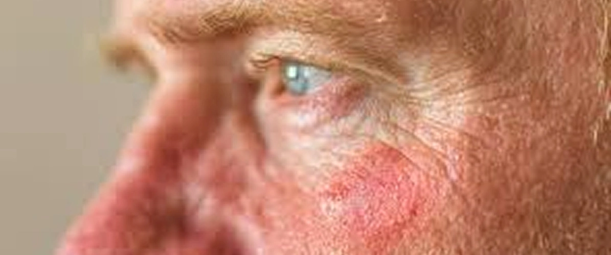 Redness Rosacea