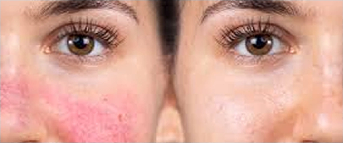 Redness Rosacea