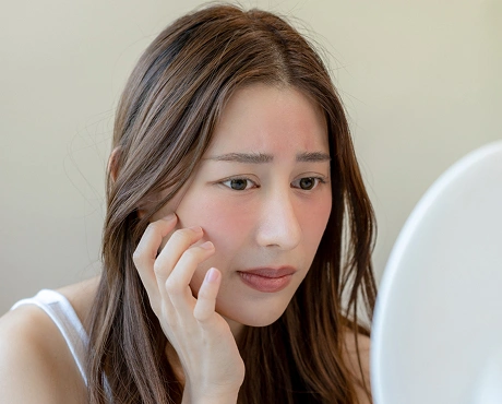 Redness Rosacea