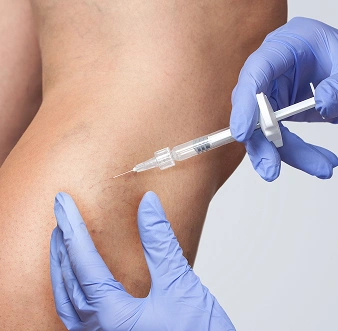 Sclerotherapy