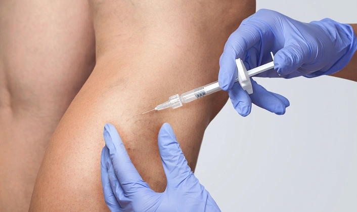 Sclerotherapy