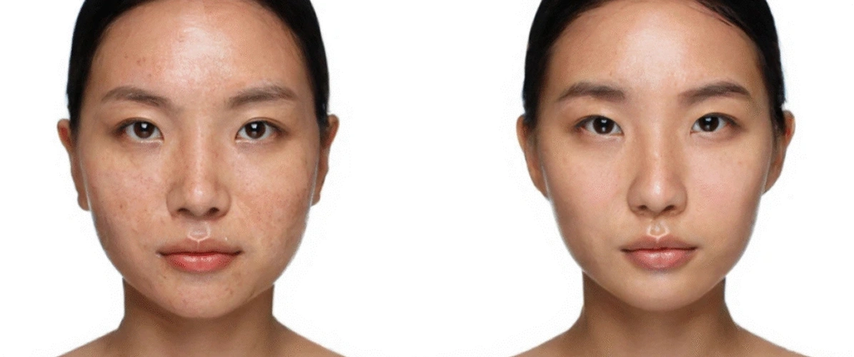 Skin Pigmentation Treatment