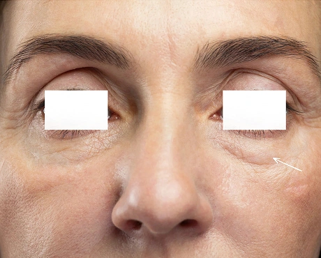 Under Eye Puffiness