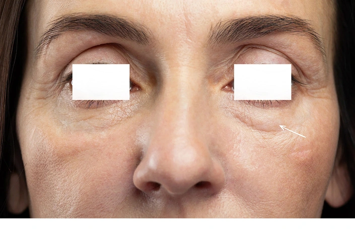 Under Eye Puffiness