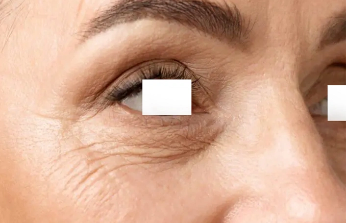 Under eye Crepeyness