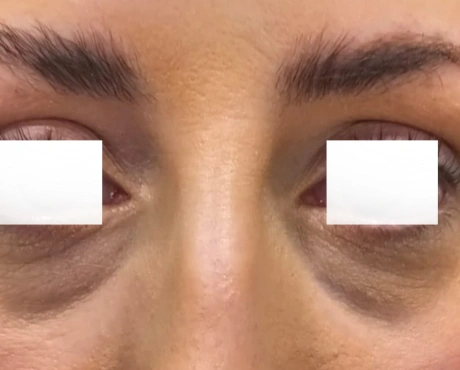 Undereye Volume Loss