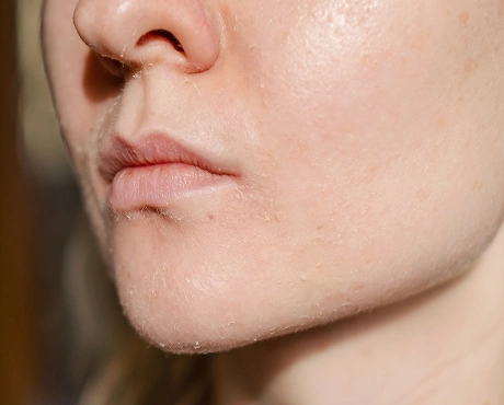 Uneven Skin Texture