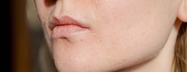 Uneven Skin Texture