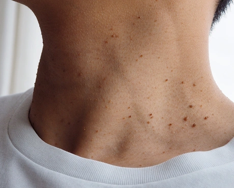Warts Skin Tags