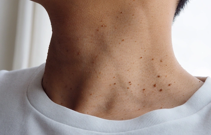 Warts Skin Tags