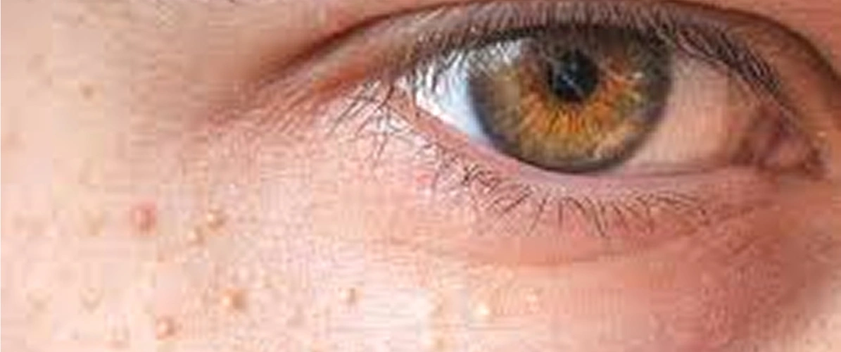 Yellowish Bumps
