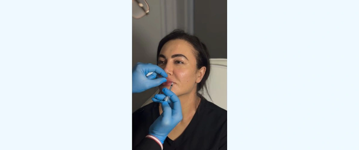 Baby Botox
