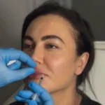 Baby Botox in Sevenoaks: Is It Right for You?