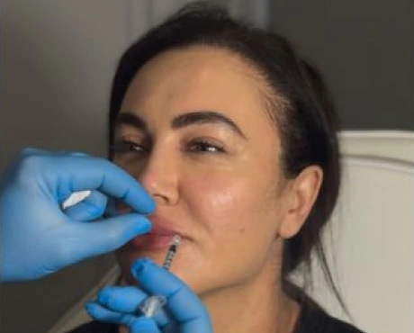 Baby Botox