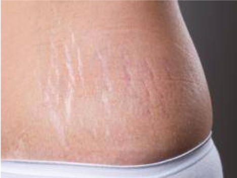 Treating Stretch Marks | Skin Clinic Sevenoaks