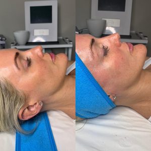 HydraFacials, What To Expect | Are HydraFacial Results Immediate?